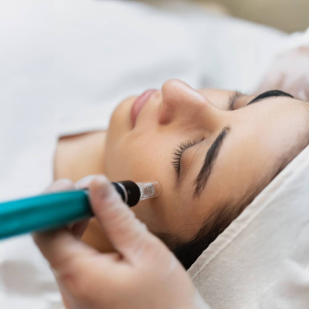 Microneedling / RF Microneedling in Castro Valley, CA