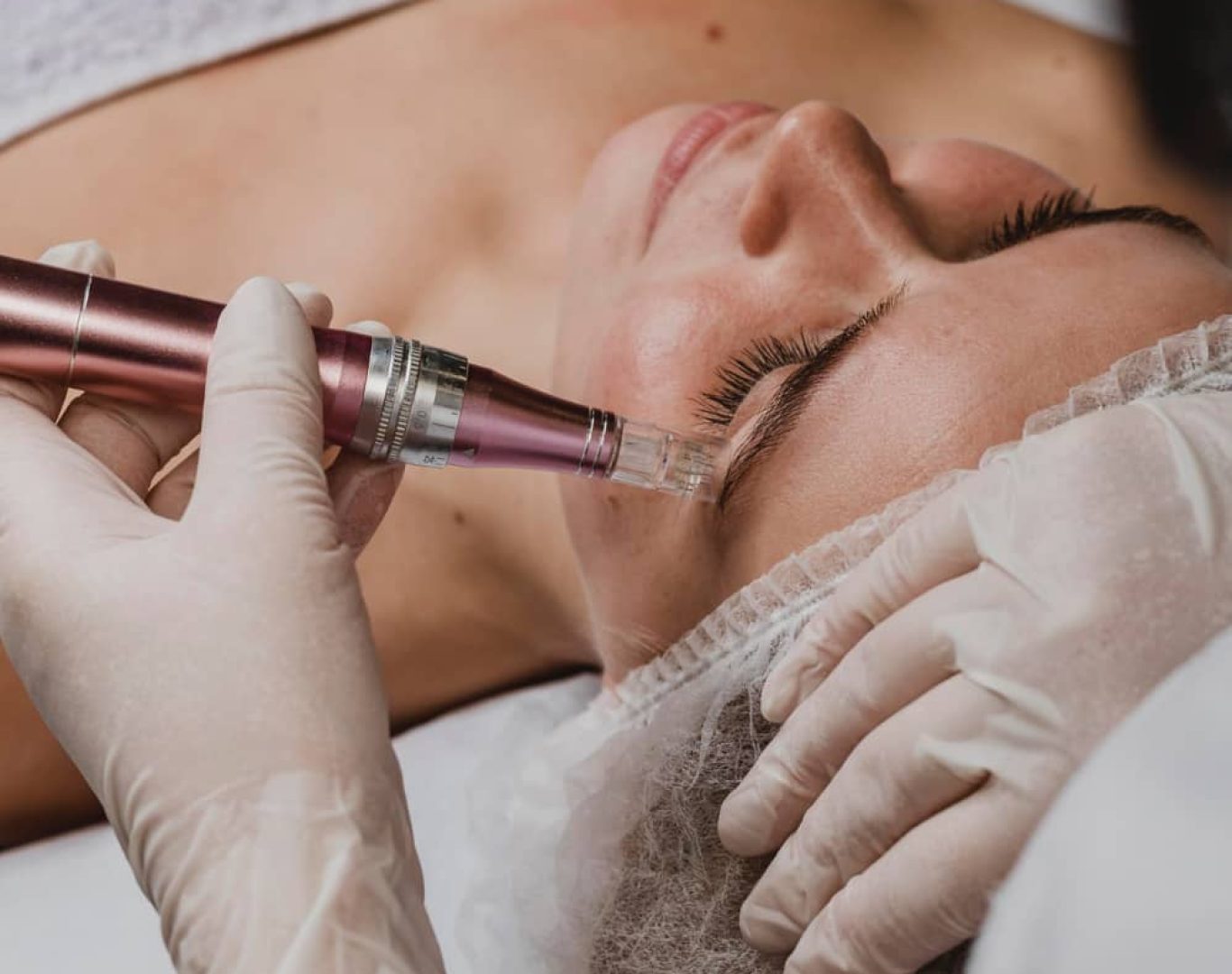 Microneedling / RF Microneedling Near Me