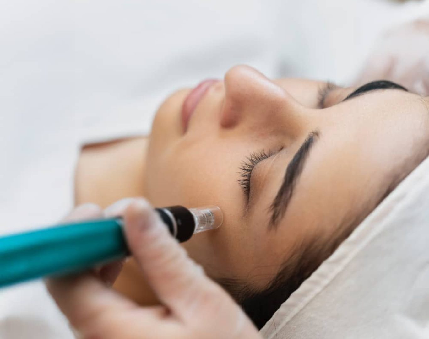 Microneedling / RF Microneedling in Castro Valley, CA
